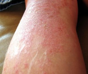 dermatitis atopica nuevo tratamiento de dermatitis atopica con dupixent foto noticia medicina